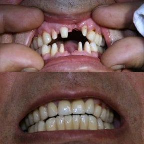 Vorher-nachher-Ergebnis Zahnimplantat mit Krone bei Smile Centrum, wiederhergestelltes Lächeln