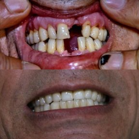 Vorher-nachher-Ergebnis Zahnimplantat mit Krone bei Smile Centrum – neues Lächeln
