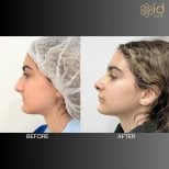 Résultats avant/après rhinoplastie à ID Clinic Bangkok, nez remodelé aspect naturel