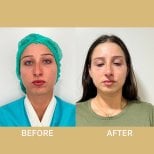Before and after septoplasty results at ID Clinic Bangkok for deviated septum correction