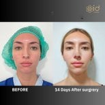Before and after septoplasty results at ID Clinic Bangkok, improved nasal symmetry visible
