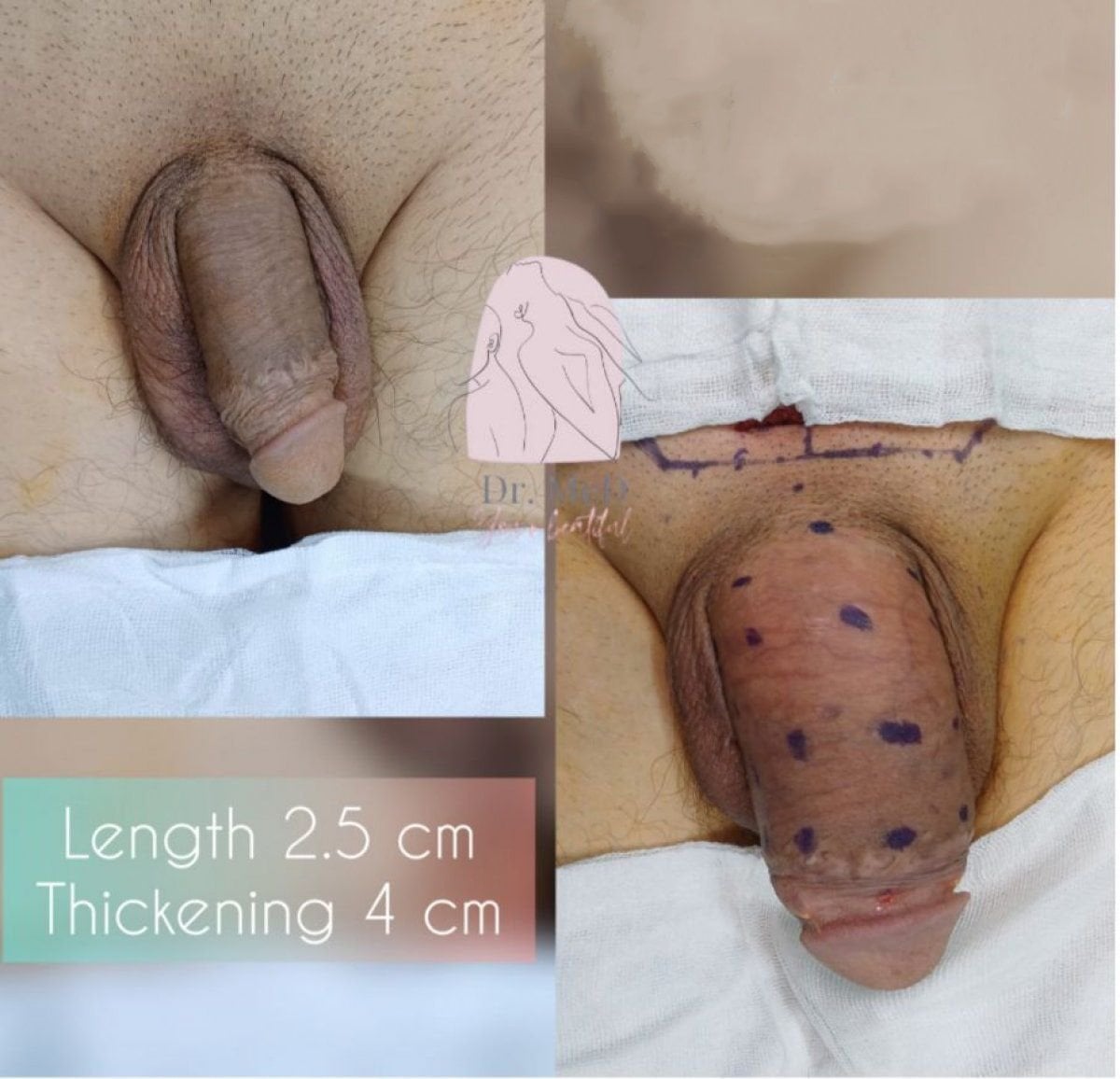 Resultados de faloplastia en Dr. MED: aumento de longitud y engrosamiento del pene