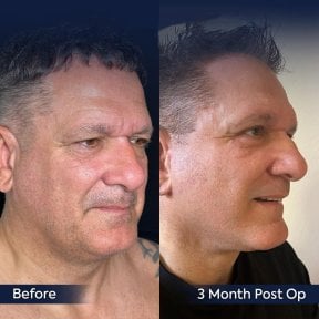Before and after neck lift results at Dr. Safa Manav Clinic, visible jawline improvement