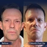 Before and after neck lift results at Dr. Safa Manav Clinic, visible neck and jawline improvement