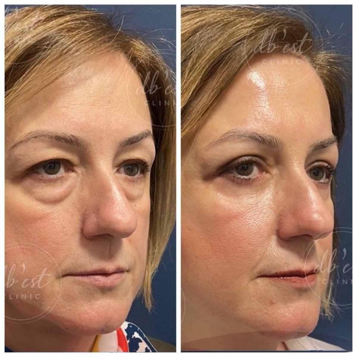 Resultados de blefaroplastia de párpado inferior antes y después en Db'est Clinic, menos bolsas