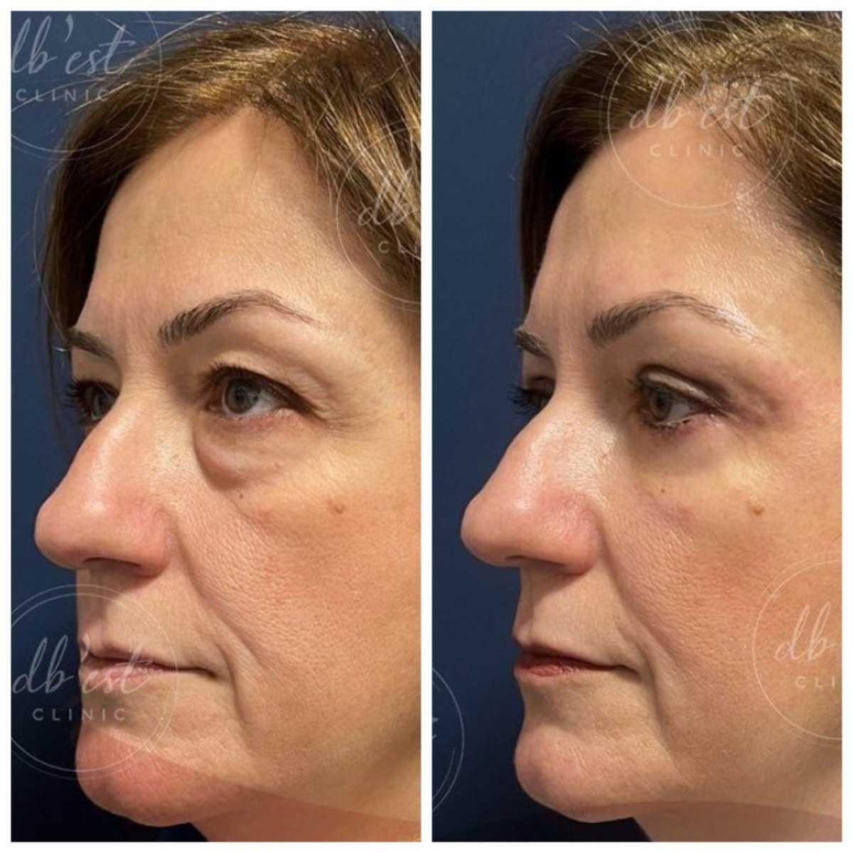 Resultados de blefaroplastia de párpado inferior antes y después en Db'est Clinic, menos bolsas
