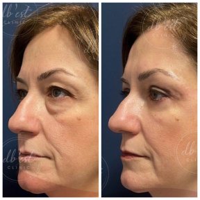 Vorher-nachher-Ergebnis Unterlid-Blepharoplastik bei Db'est Clinic, weniger Augenringe