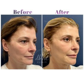 Vorher-nachher-Ergebnis Unterlid-Blepharoplastik bei Db'est Clinic, reduzierte Augenringe