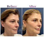 Vorher-nachher-Ergebnis Unterlid-Blepharoplastik bei Db'est Clinic, reduzierte Augenringe