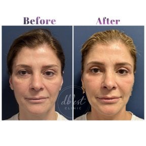 Vorher-nachher-Ergebnis Unterlid-Blepharoplastik bei Db'est Clinic, verjüngte Augenpartie