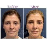 Vorher-nachher-Ergebnis Unterlid-Blepharoplastik bei Db'est Clinic, verjüngte Augenpartie