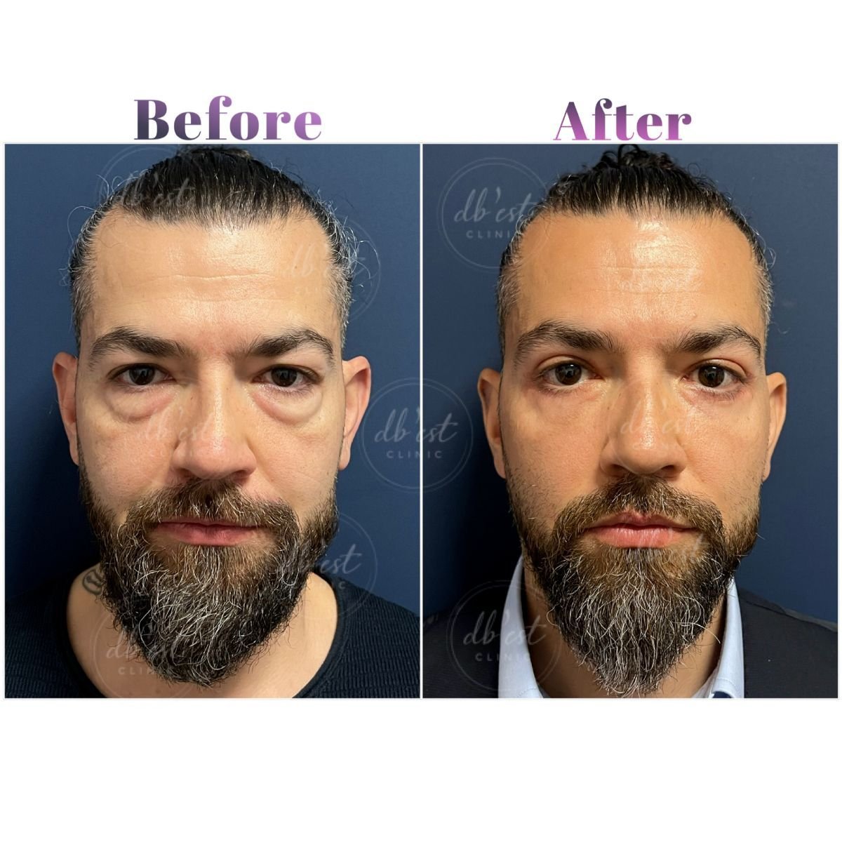 Resultados de blefaroplastia de párpado inferior antes y después en Db'est Clinic, menos bolsas
