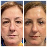 Vorher-nachher-Ergebnis Unterlid-Blepharoplastik bei Db'est Clinic, reduzierte Augenringe