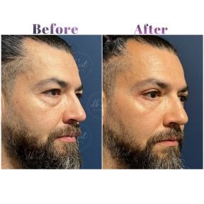 Vorher-nachher-Ergebnis Unterlid-Blepharoplastik bei Db'est Clinic, reduzierte Augenringe