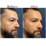 Vorher-nachher-Ergebnis Unterlid-Blepharoplastik bei Db'est Clinic, reduzierte Augenringe