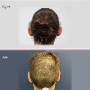 Otoplastik Vorher-Nachher-Ergebnisse bei Db'est Clinic – verbesserte Ohrform und Position