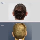 Otoplastik Vorher-Nachher-Ergebnisse bei Db'est Clinic – verbesserte Ohrform und Position