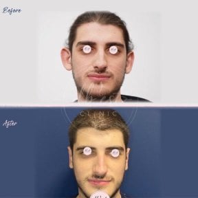 Otoplastik Vorher-Nachher-Ergebnisse bei Db'est Clinic, verbesserte Ohrform und Symmetrie