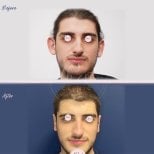 Otoplastik Vorher-Nachher-Ergebnisse bei Db'est Clinic, verbesserte Ohrform und Symmetrie