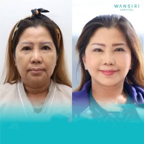 Before and after facelift results at Wansiri Hospital, visible facial rejuvenation and lift