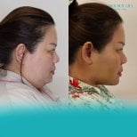 Before and after liposuction at Wansiri Hospital, visible facial contouring result
