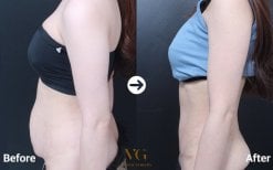 Результати до і після абдомінопластики у VG Plastic Surgery – покращення контуру живота