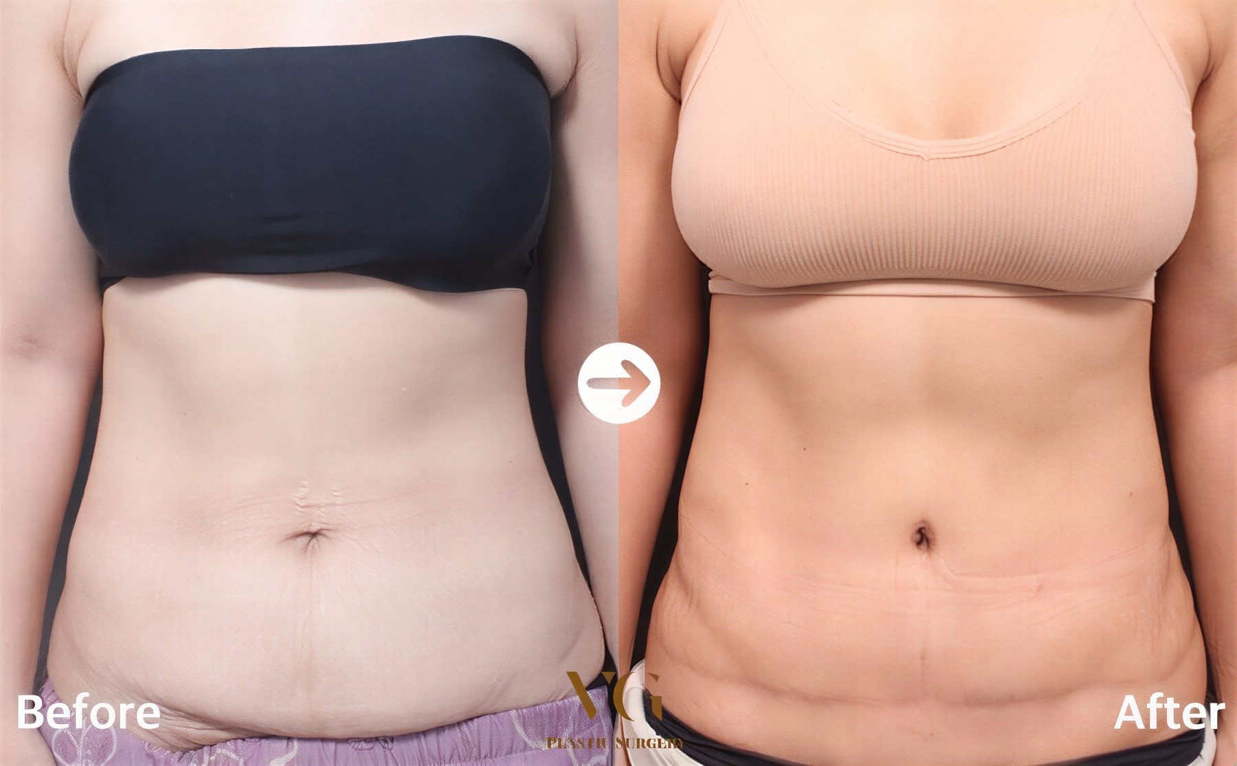 Resultados antes y después de Vaser 3 áreas más abdominoplastia en VG Plastic Surgery