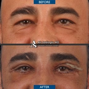 Vorher-nachher-Ergebnis der Blepharoplastik in der Dr. Safa Manav Klinik, Lidkorrektur