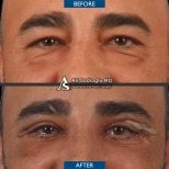 Vorher-nachher-Ergebnis der Blepharoplastik in der Dr. Safa Manav Klinik, Lidkorrektur