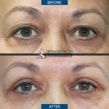 Vorher-nachher-Ergebnis der Blepharoplastik in der Dr. Safa Manav Klinik, Lidkorrektur