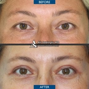 Blepharoplastik Vorher-Nachher-Ergebnis in der Dr. Safa Manav Klinik, Lidkorrektur