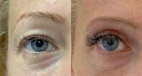 Blepharoplastik Vorher-Nachher-Ergebnis bei Dr. Safa Manav Clinic, Lidkorrektur