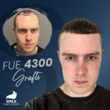 Результат пересадки волос FUE 4300 графтов до и после в Smile Hair Clinic Турция