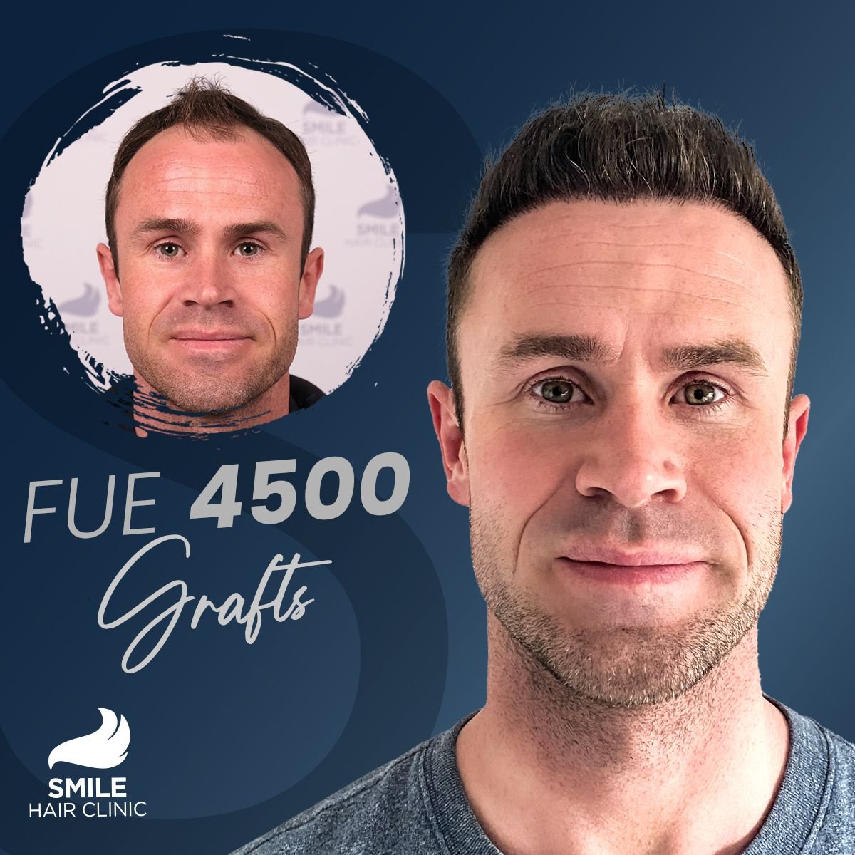 نتائج زراعة الشعر FUE 4500 بصيلة قبل وبعد في Smile Hair Clinic تركيا