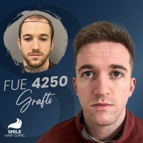 Результат пересадки волос FUE 4250 графтов до и после в Smile Hair Clinic Турция