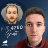 Результат пересадки волос FUE 4250 графтов до и после в Smile Hair Clinic Турция