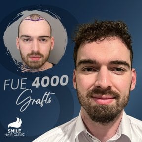 Результат пересадки волос FUE 4000 графтов до и после в Smile Hair Clinic в Турции