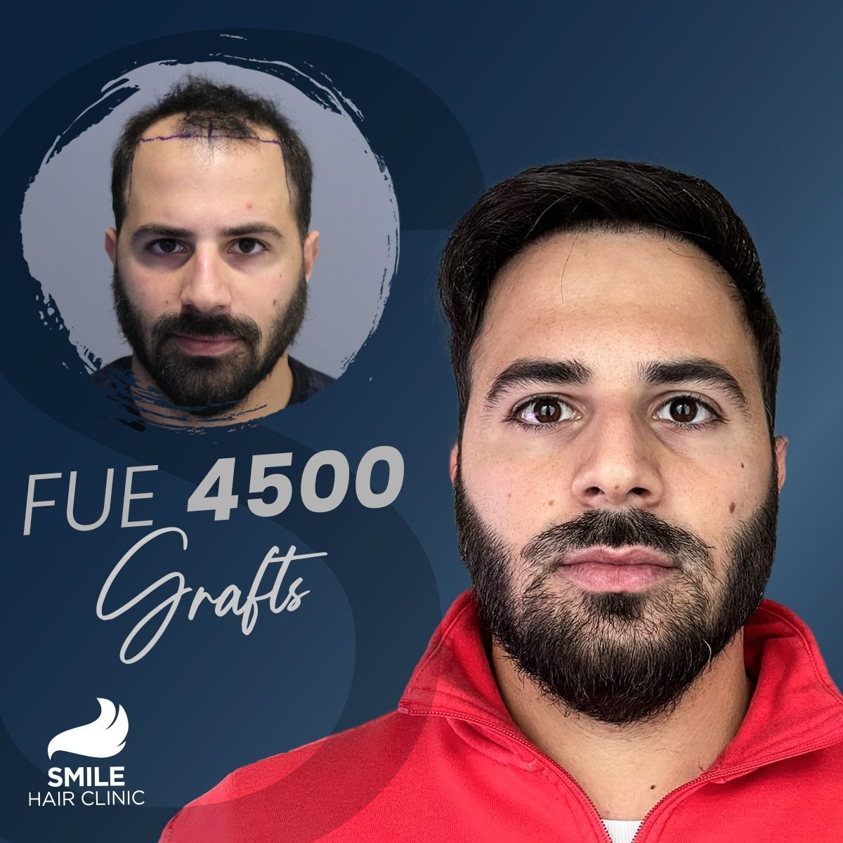 FUE Haartransplantation 4500 Grafts Vorher-Nachher-Ergebnis bei Smile Hair Clinic Türkei