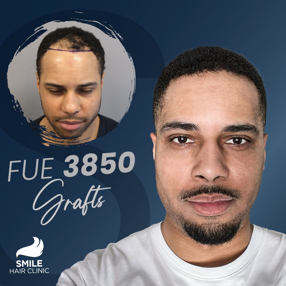 FUE-Haartransplantation 3850 Grafts Vorher-Nachher-Ergebnis bei Smile Hair Clinic Türkei
