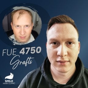 نتيجة زراعة الشعر FUE 4750 بصيلة قبل وبعد في Smile Hair Clinic تركيا