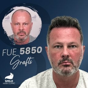نتيجة زراعة الشعر FUE 5850 بصيلة قبل وبعد في Smile Hair Clinic تركيا