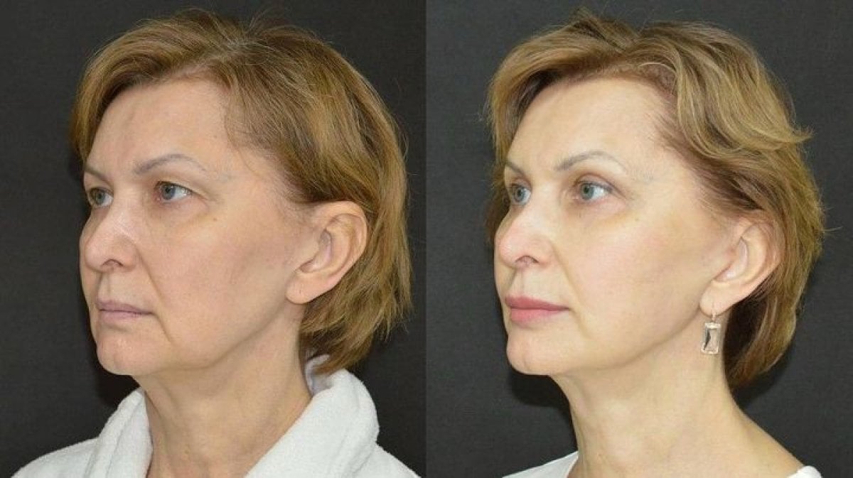نتائج جراحة الجفن العلوي قبل وبعد في عيادة دميتري هومولا، تجديد منطقة العين
