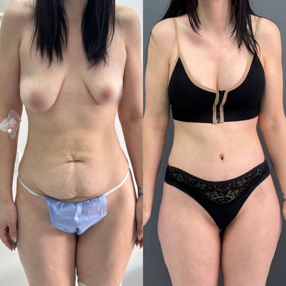 Resultados antes y después de lifting corporal completo en Dmytrii Homola Clinic, mejor contorno