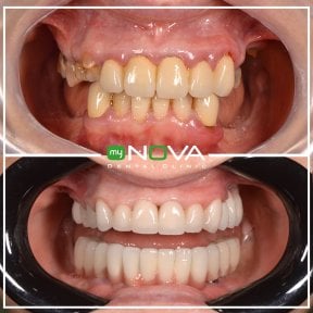 Before and after veneers results at My Nova Kusadasi Dental Clinic, smile transformation