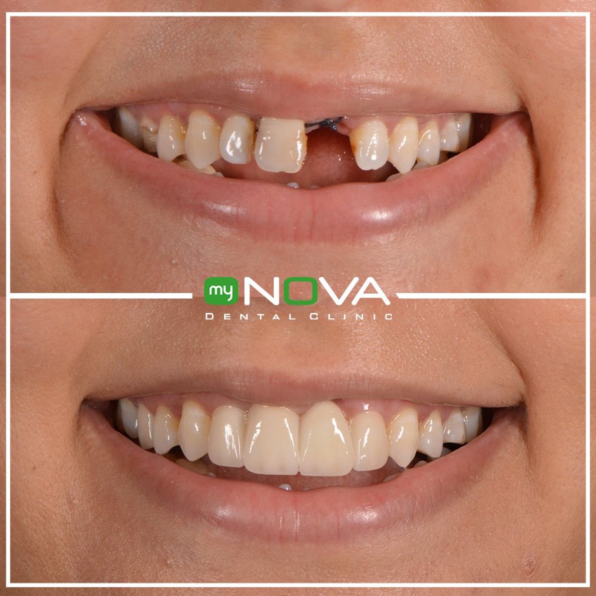 Antes y después de carillas dentales en My Nova Kusadasi Dental Clinic, restauración de sonrisa