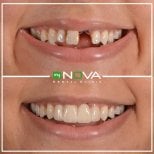 Before and after veneers at My Nova Kusadasi Dental Clinic, smile restoration results