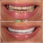 Before and after veneers result at My Nova Kusadasi Dental Clinic – smile transformation