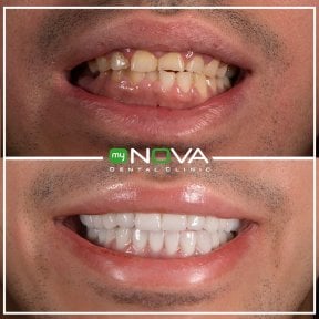 Before and after veneers result at My Nova Kusadasi Dental Clinic, smile transformation
