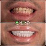 Before and after veneers result at My Nova Kusadasi Dental Clinic, smile transformation