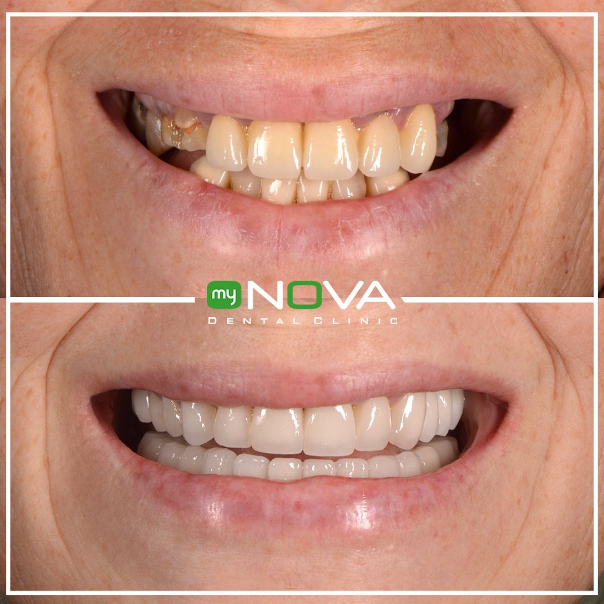 نتائج قبل وبعد الفينير في My Nova Kusadasi Dental Clinic، تحسين الابتسامة